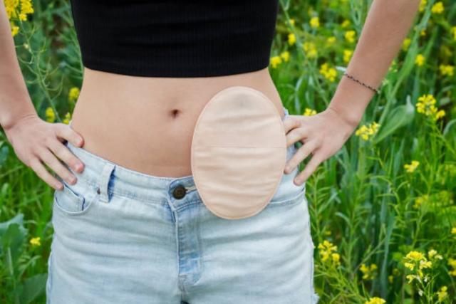 Bolsa de urostomía Bolsa de urostomía